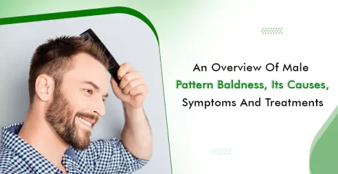 An Overview of Male Pattern Baldness, Its Causes, Symptoms and Treatments