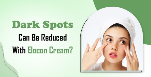 Dark Spots Can Be Reduced Elocon Cream