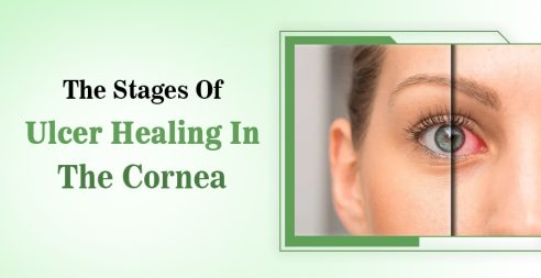 Stages Of Ulcer Healing In The Cornea