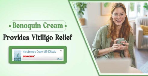 Benoquin Cream Treats Vitiligo
