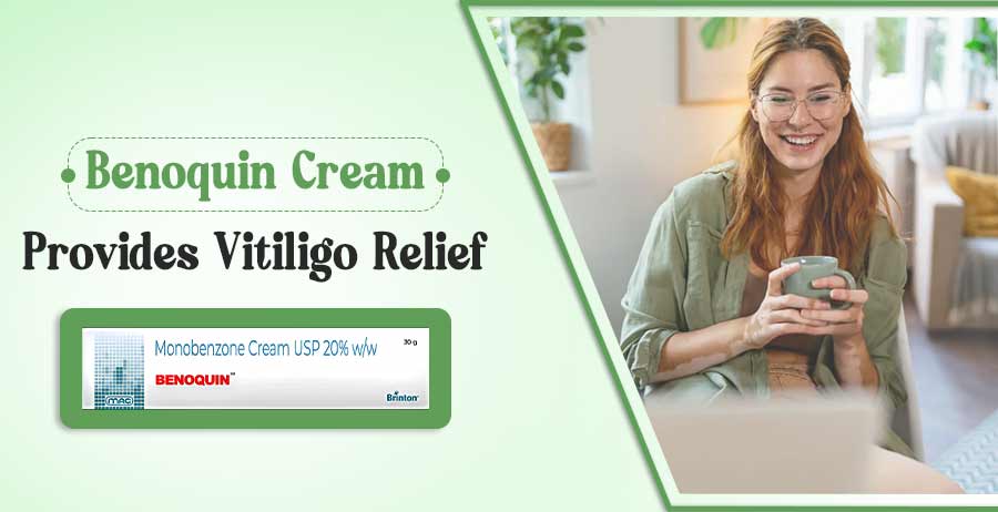 Benoquin Cream Treats Vitiligo
