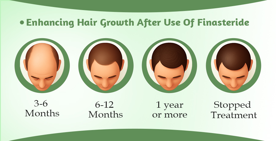 Finasteride For Hair Growth: When Should You Take It 7 Hair Growth