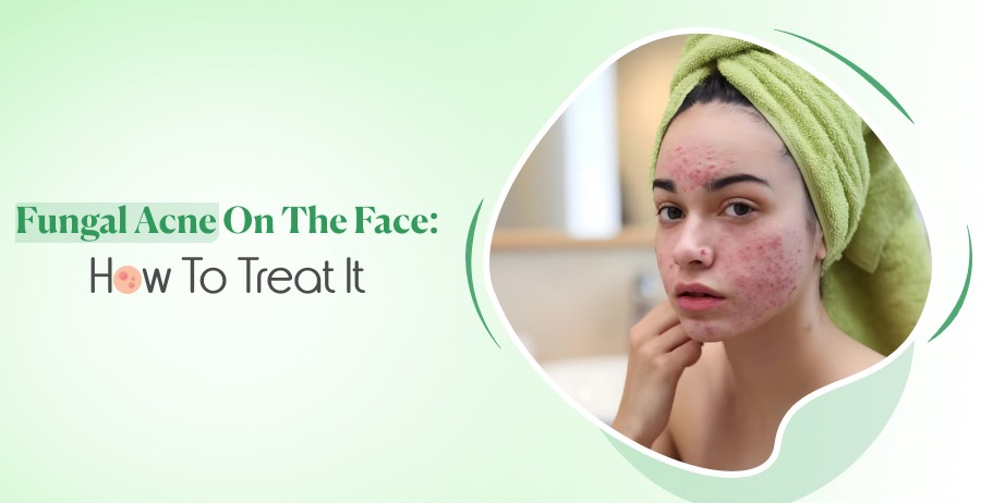 Fungal Acne On The Face: How To Treat It 1 Fungal Acne On The Face